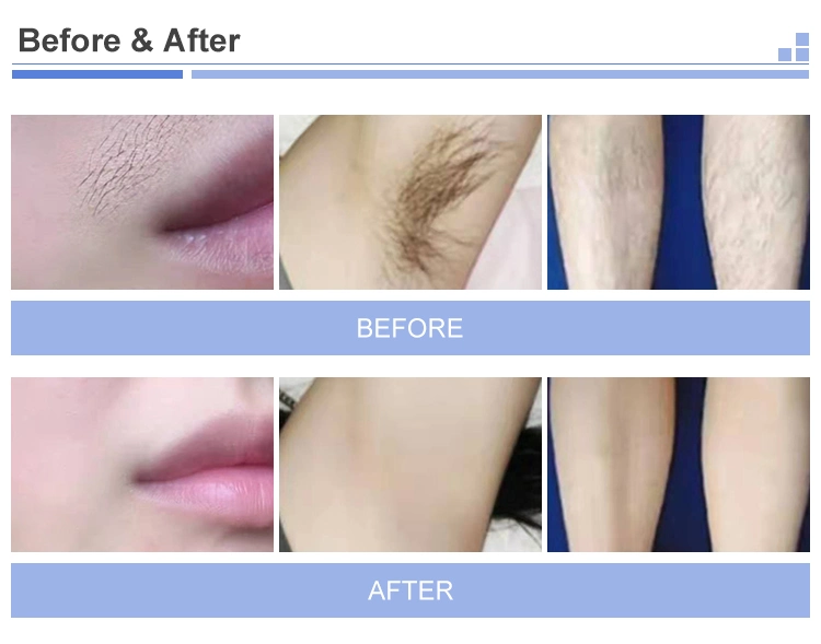 Medical Laser Distributors Cosmetics Titanium 808nm Diode Laser Hair Removal Machine Beauty Salon Skin Care Facial Equipment Supplier
